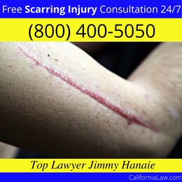 Chinese Camp Scarring Injury Lawyer CA