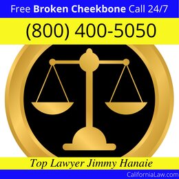 Acampo Broken Cheekbone Lawyer