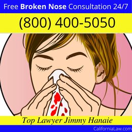 Best Acampo Broken Nose Lawyer