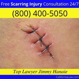 Licensed Scarring Injury Lawyer For California